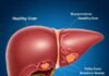 How Alcohol Affects Your Liver: What You Need to Know Healthy vs. Damaged Liver